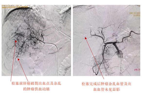 肝癌破裂大出血命悬一线——日韩无码
急诊介入止血化险为夷